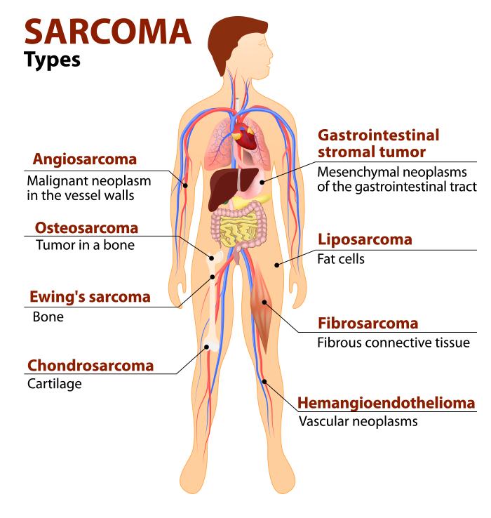 aggressive cancer of the soft tissue